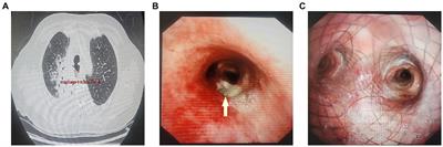 A novel method for precise implantation of tracheal Y-shaped stent